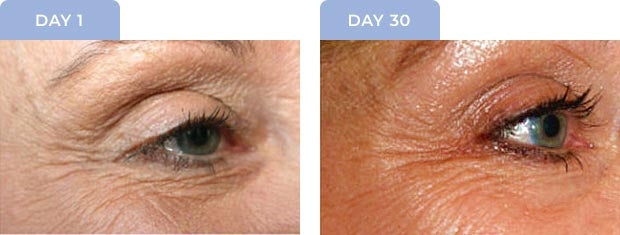 Original eye-area photographs, Day 1 and Day 30, Elevate and Liquid Gold routine