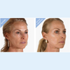 Hi-Impact Illuminating Serum  with Hyaluronic Acid, Vitamin C and EGF's - 0.5 oz 15 mL