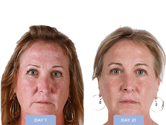 Original facial photographs, Day 1 and Day 21, Daily Micro Derm Scrub, Liquid Gold and Boost routine