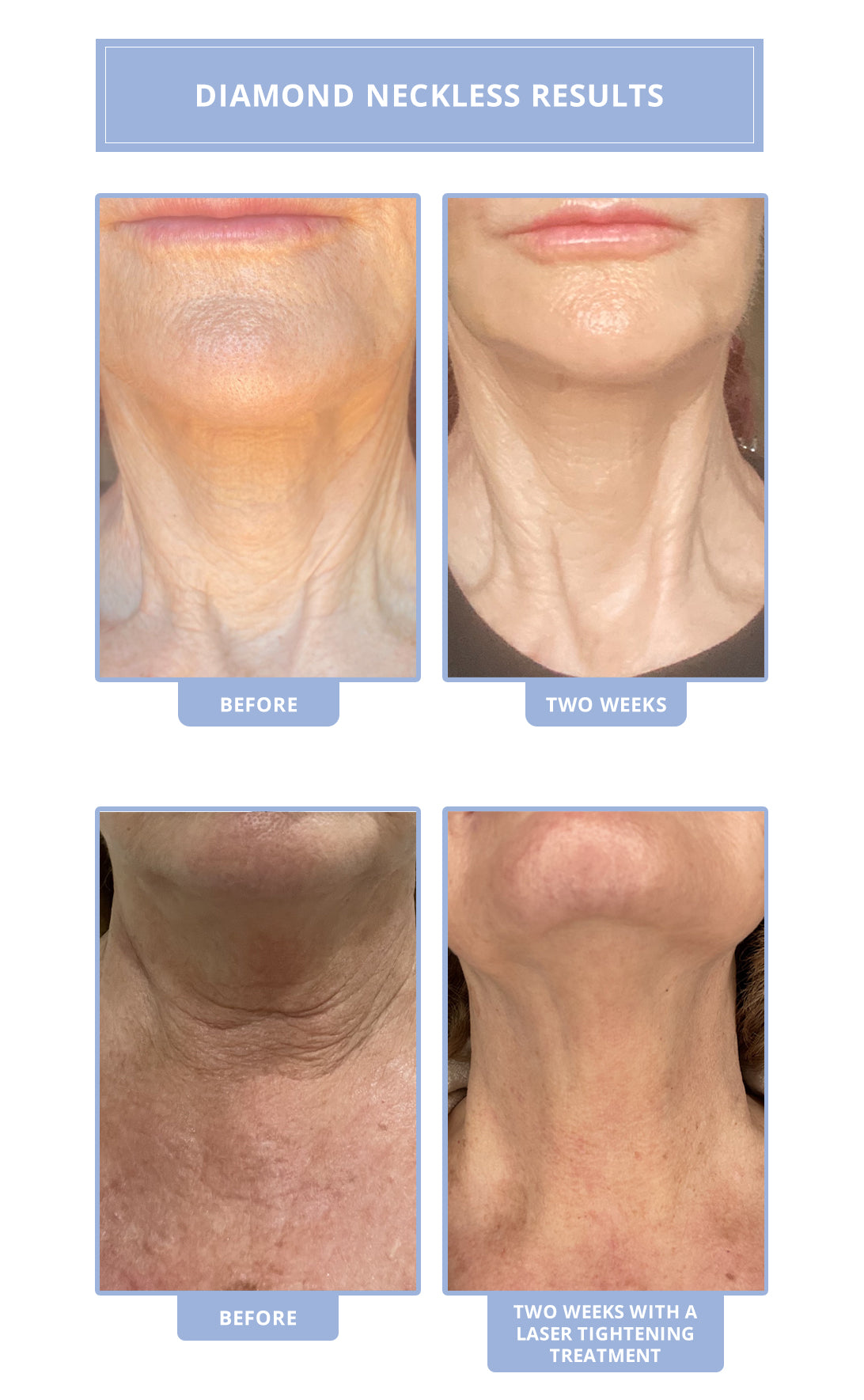 Diamond Neckless lifts and tightens the sagging neck skin